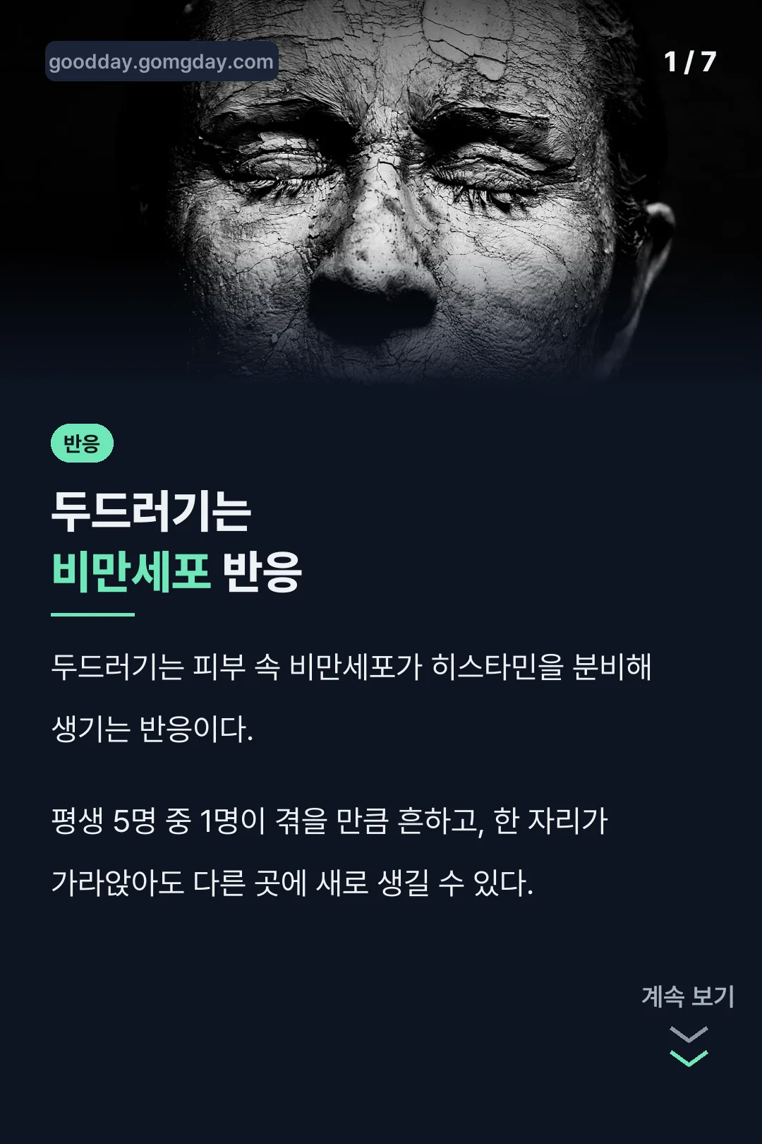 두드러기 비만세포 반응 소개