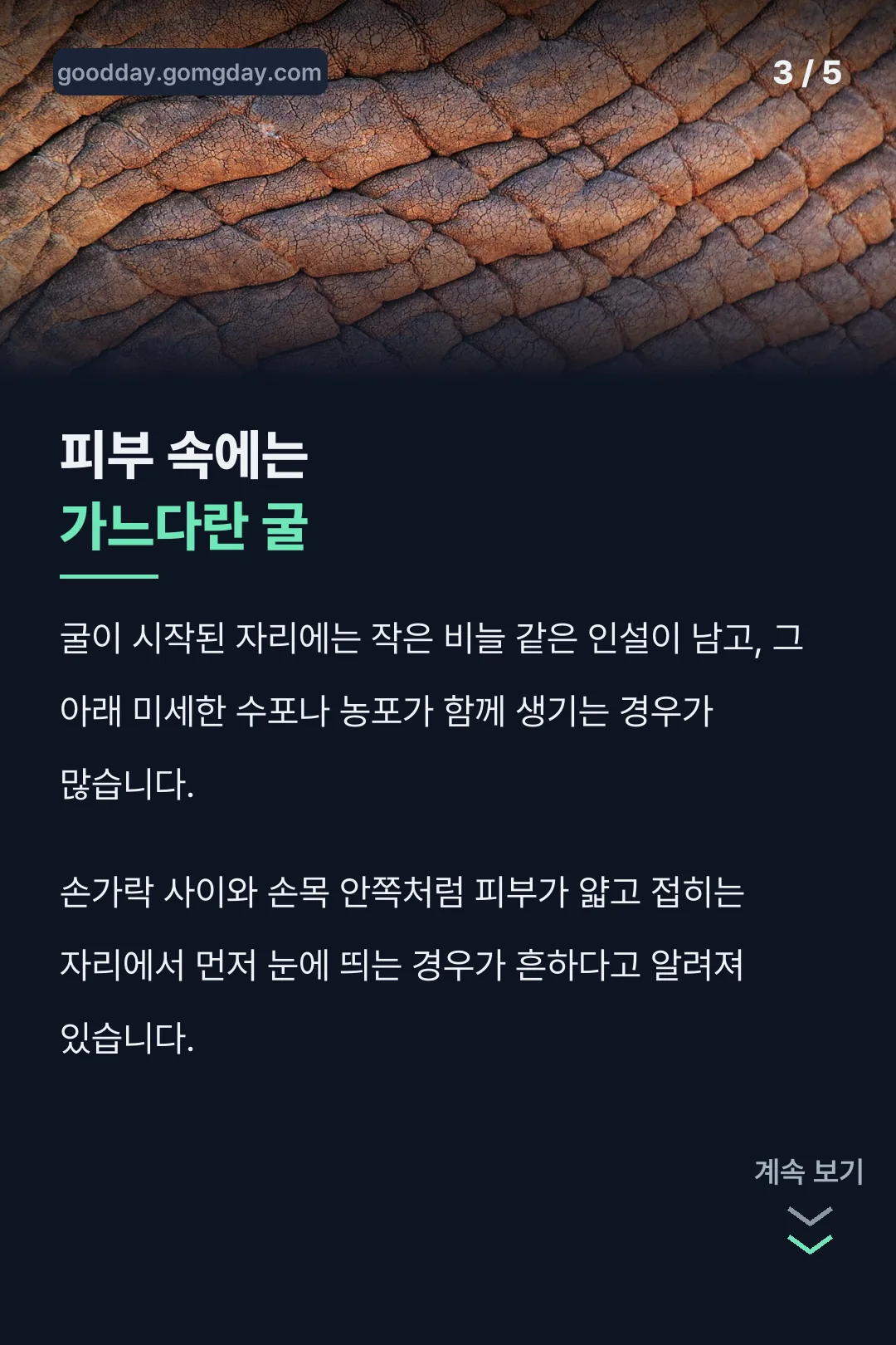 피부 속 굴 자국 특징